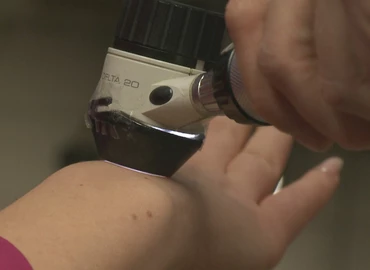 Télen felerősödhetnek az ekcémás panaszok