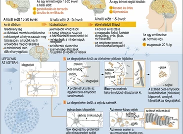 Herpeszvírusok állhatnak az Alzheimer-kór hátterében egy új kutatás szerint