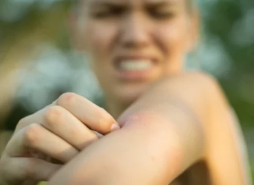 Évről-évre súlyosabb bőrreakciókat produkál a szúnyog- és darázscsípés